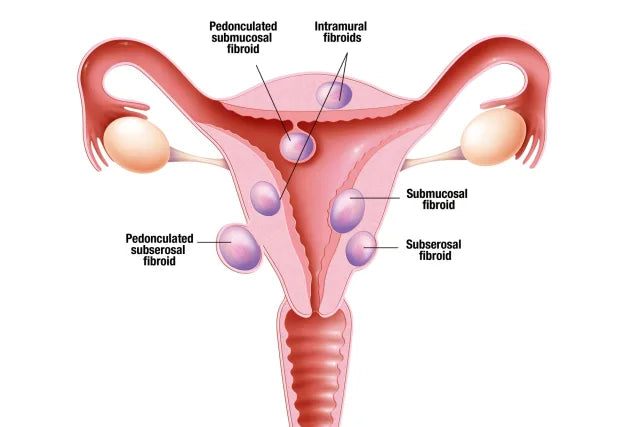 What are Fibroids?