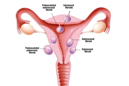 What are Fibroids?